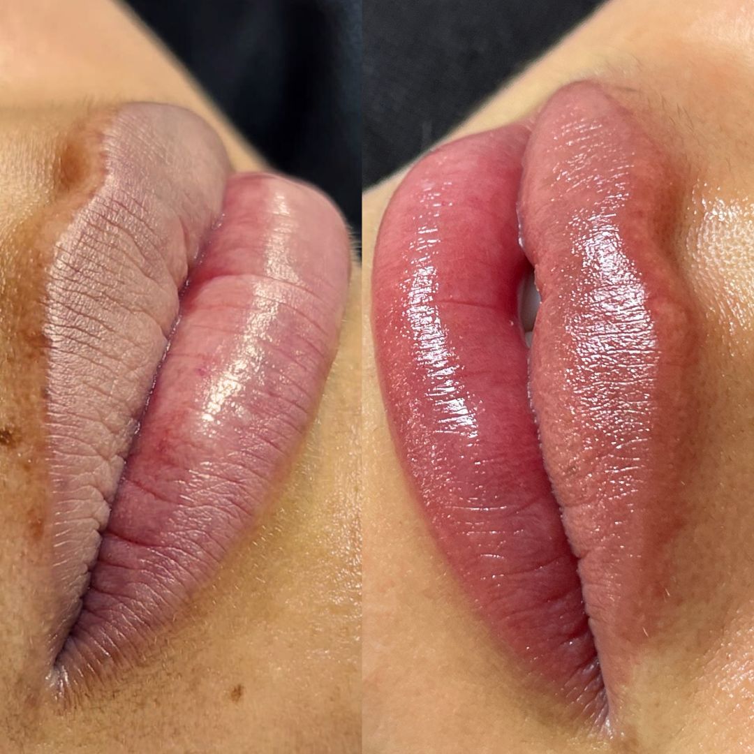 Micropigmentación para aclarar labios