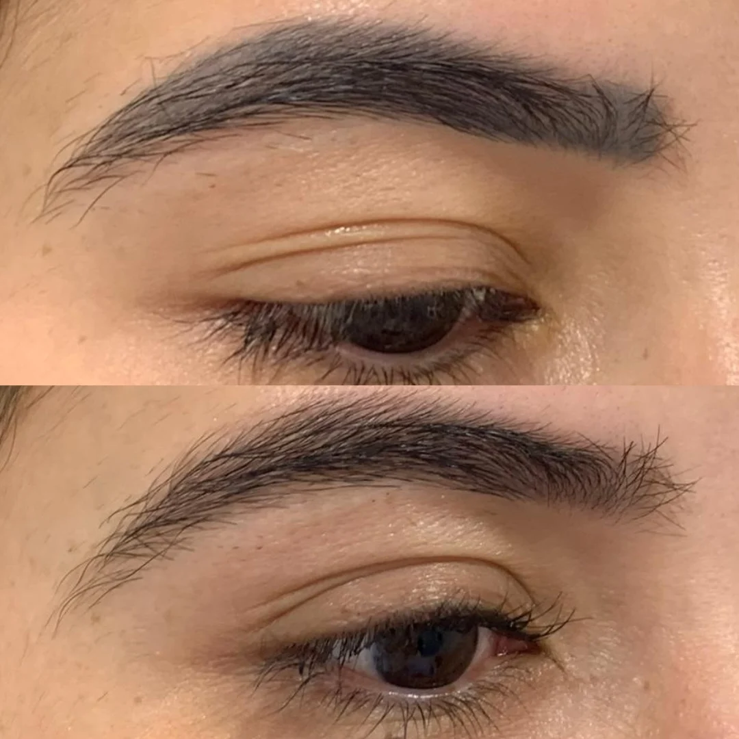 Remoción de tatuaje de cejas en Pereira