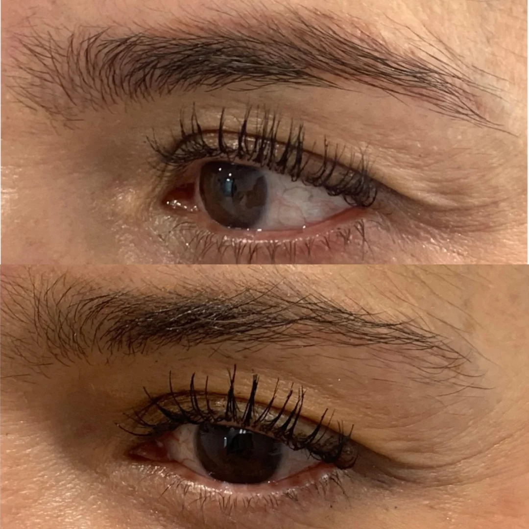 Eliminación de maquillaje permanente con láser en Pereira