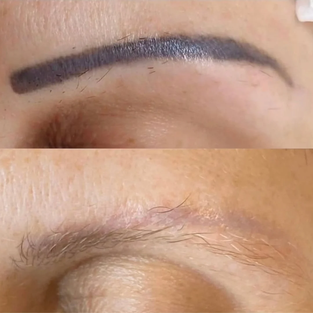 Remoción de micropigmentación de cejas en Pereira